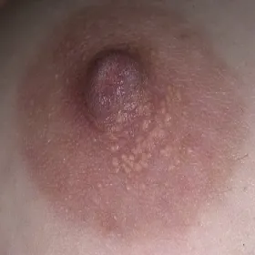 Plamki fordyce'a na sutku choroba Foxa-Fordyce'a