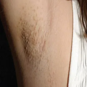 Plamki fordyce'a pod pachą