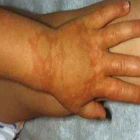 Plamy na dłoniach u dzieci rumień zakaźny