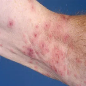 Plamy na nadgarstku rumień wielopostaciowy