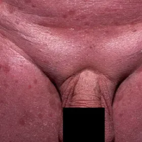 Plamy na skórze miejsca intymne zespół Sezary’ego 