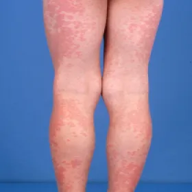 Plamy na skórze nóg 