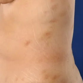 Plamy na skórze przyłuszczyca