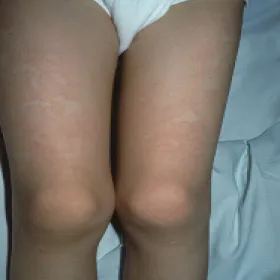 Plamy na skórze u dziecka na nogach rumień zakaźny