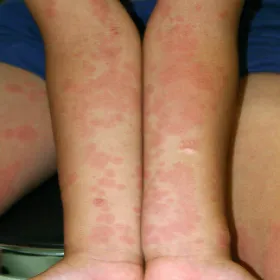 Plamy na skórze u dziecka na rękach rumień zakaźny