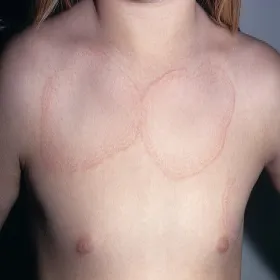 Plamy na skórze zdjęcia ziarniniak obrączkowaty 