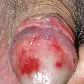 Plasma cell vulvitis