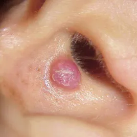 Pod nosem guzek ziarniniak ropotwórczy 