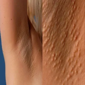 Pod pachą guzki choroba Foxa-Fordyce'a