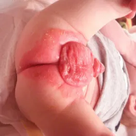 Podrażnienie skóry okolicy wewnętrznej strony ud u niemowląt 