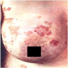 Podrogowa dermatoza krostkowa na piersi