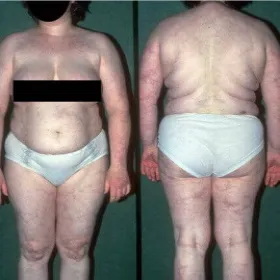 Podrogowa dermatoza krostkowa objawy