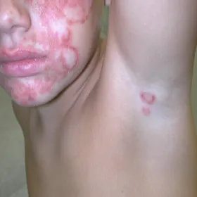 Podrogowa dermatoza krostkowa u dziecka