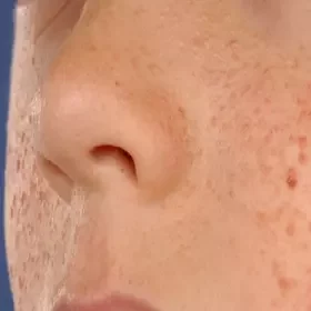 Podskórne grudki na twarzy gruczolak łojowy
