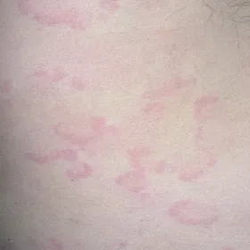 Pokrzywka alergiczna żywność orzechy