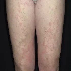 Pokrzywka alergiczna na lateks