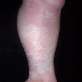 Pokrzywka alergiczna na słońce