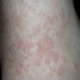 Pokrzywka alergiczna na stres