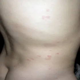 Pokrzywka alergiczna polekowa