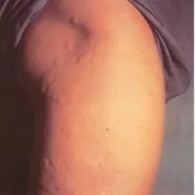 Pokrzywka cholinergiczna na nogach