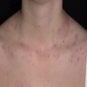 Pokrzywka cholinergiczna na skórze