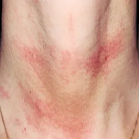 Pokrzywka cholinergiczna na szyi