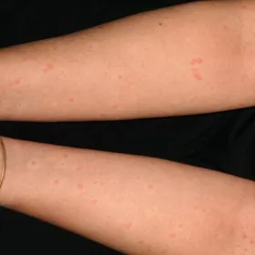 Pokrzywka cholinergiczna rąk