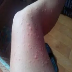 Pokrzywka cholinergiczna u dzieci