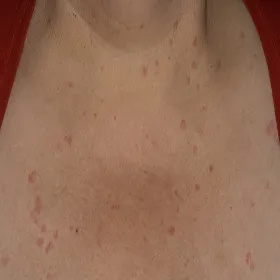 Pokrzywka cholinergiczna zdjęcie