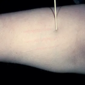 Pokrzywka dermograficzna obrazy   