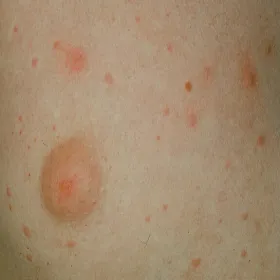 Pokrzywka u sportowców pokrzywka cholinergiczna 