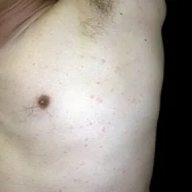 Pokrzywka u trenujących pokrzywka cholinergiczna 