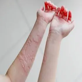 Pokrzywka polekowa u dzieci