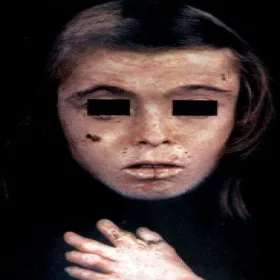 Porfiria skórna choroba zdjęcie