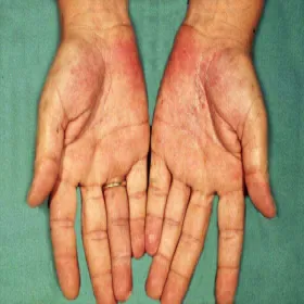 Potnica na dłoniach