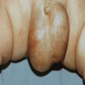 Powiększenie jąder u dziecka wodniak