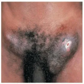 Powiększone węzły chłonne pachwinowe