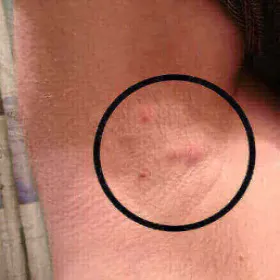 Powiększone węzły chłonne pod pachami u dorosłych