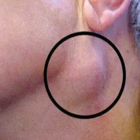 Powiększone węzły chłonne podżuchwowe