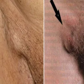 Powiększony węzeł chłonny w pachwinie 