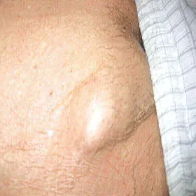 Powiększone węzły chłonne w pachwinie u mężczyzny