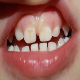 Próchnica butelkowa początki