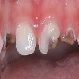 Próchnica u dwulatka 