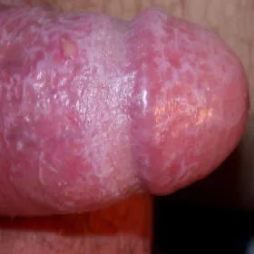 Prącie biały nalot o nieprzyjemnym zapachu balanitis