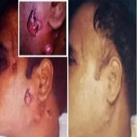 Promienica zdjęcia choroby