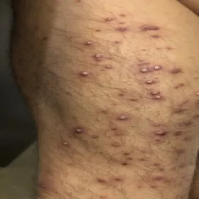 Pryszcze ropne na nodze