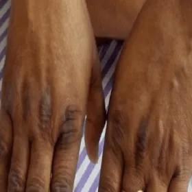 Przebarwienia na dłoniach choroba Addisona