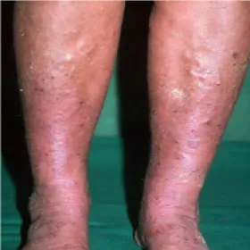 Przebarwienia na nogach wyprysk podudzi