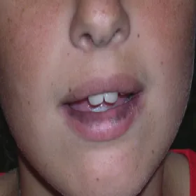 Przebarwienia na ustach choroba Addisona 