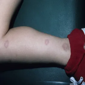 Przebarwienia skórne na nogach u dziecka ziarniniak obrączkowaty 